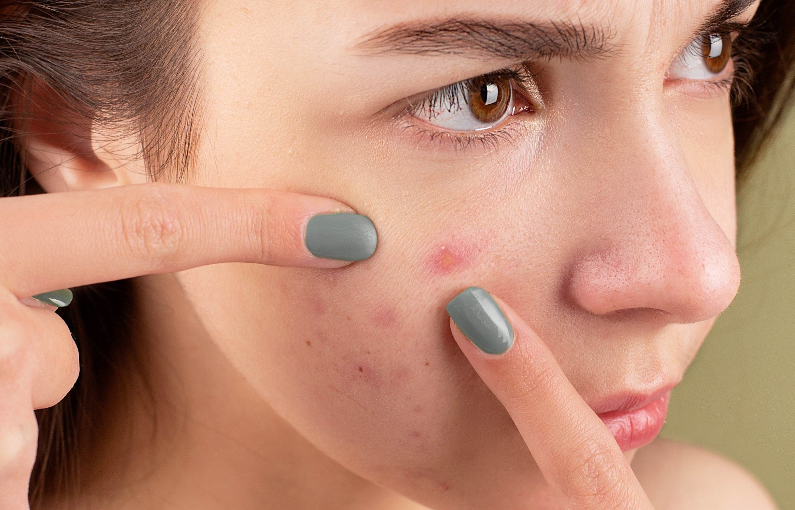 HOW TO REDUCE ACNE NATURALLY?